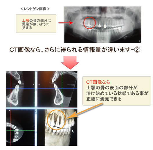 CT(3D画像)