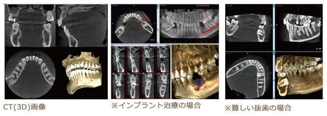 CT(3D画像)